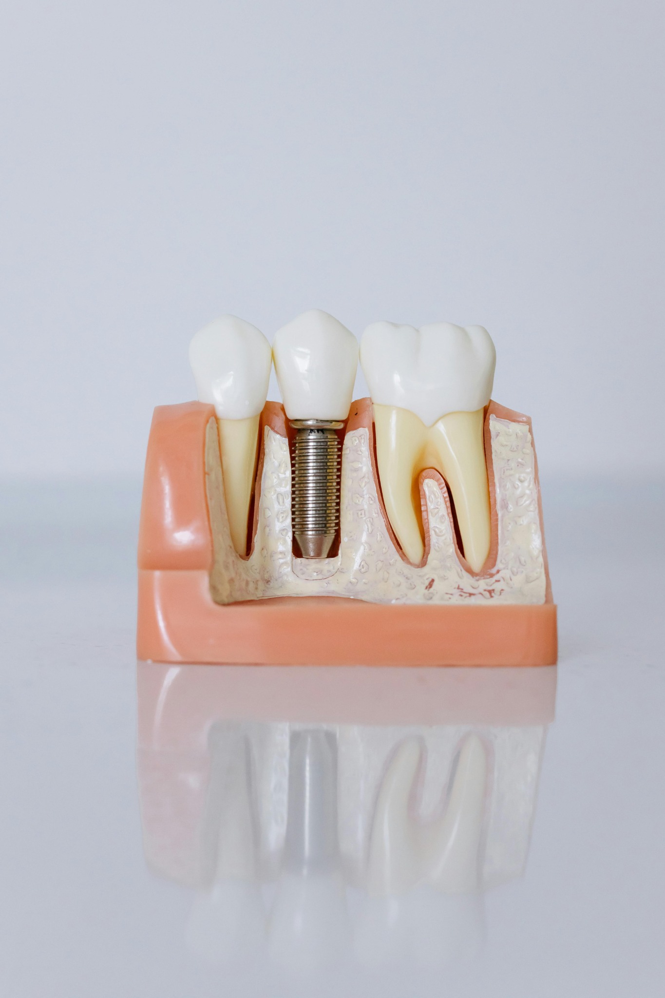 Implantes Dentários